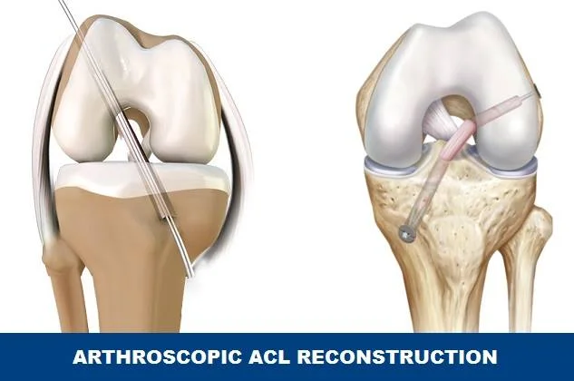 Arthroscopic ACL Reconstruction - Diagram